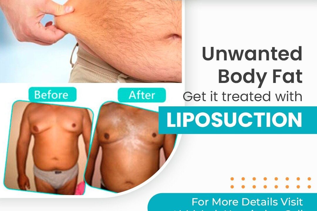 Liposuction Surgery and Its Benefits