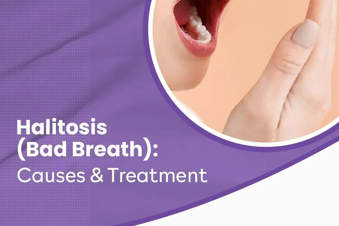 Halitosis (Bad Breath): Causes & Treatment