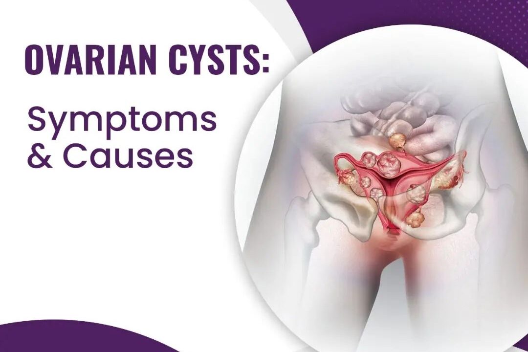 Ovarian cysts: Symptoms & Causes