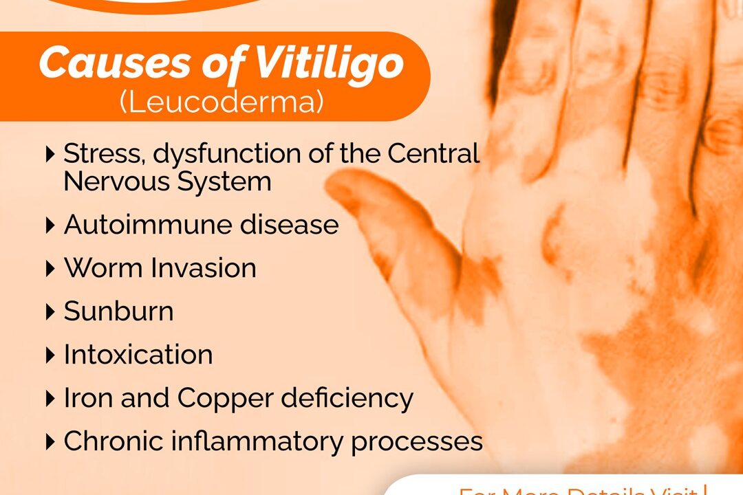 Causes of Vitiligo