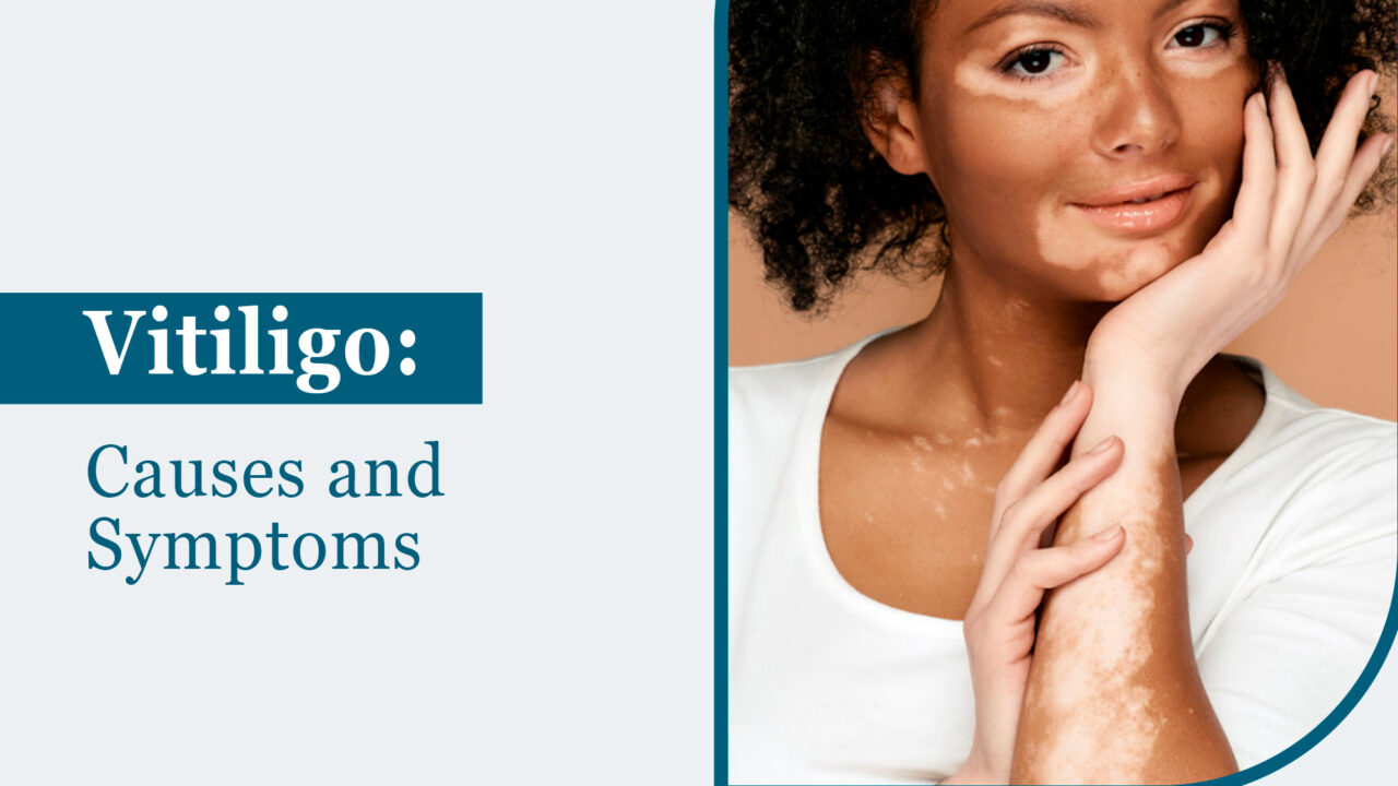 Vitiligo: Causes and Symptoms