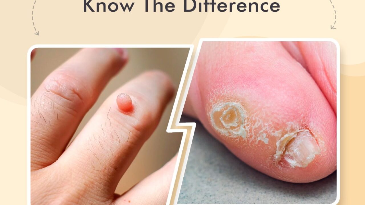 Wart vs. Corn- Know the Difference