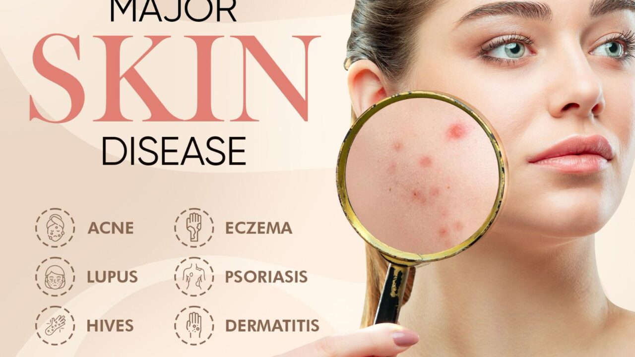 Know About Major Skin Disease