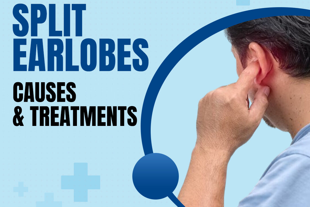 Split Earlobes Causes & Treatments