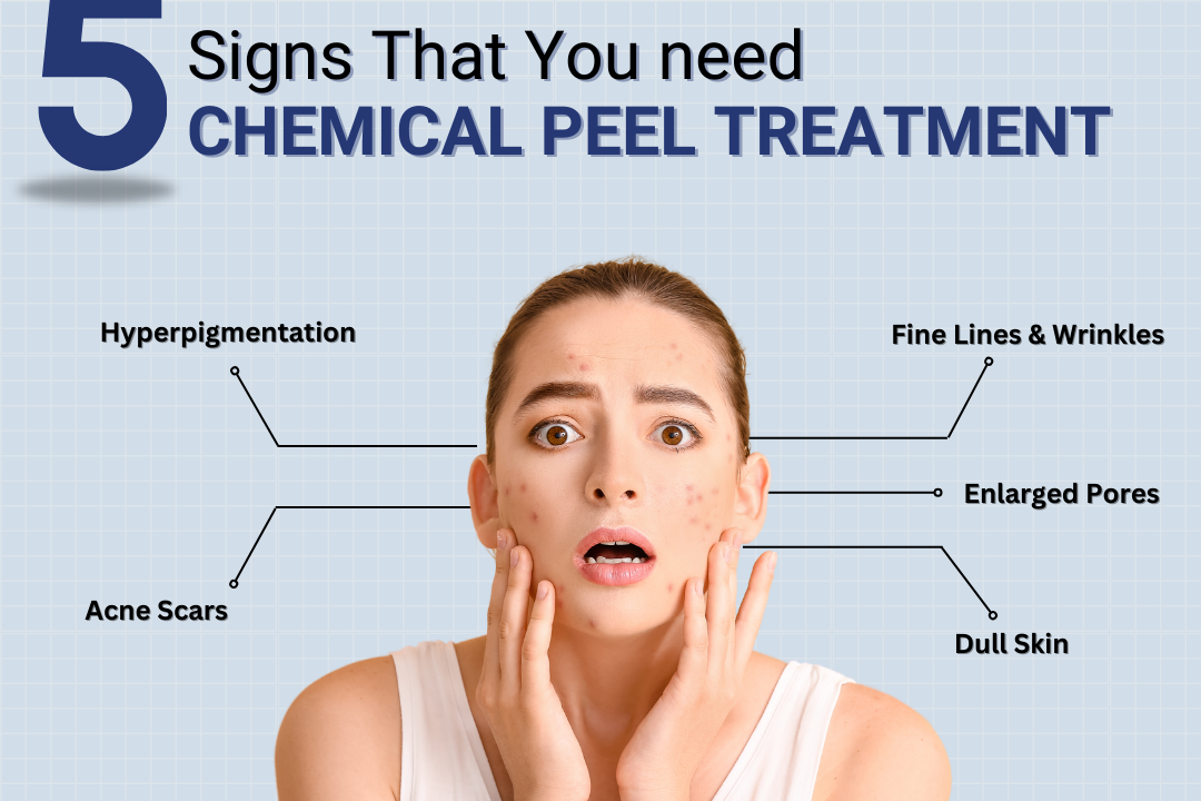 5 Signs You May Need Chemical Peel Treatment