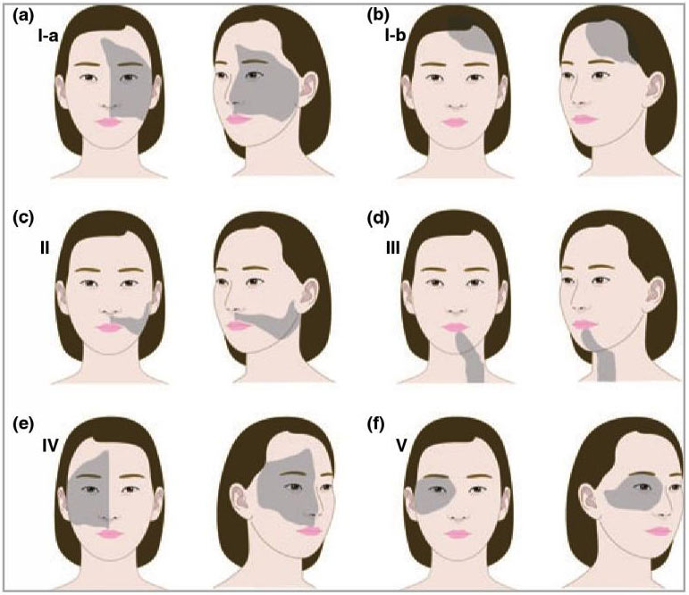 Vitiligo treatment - transplantation